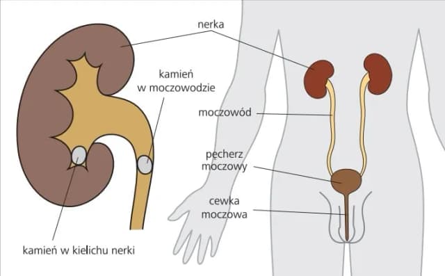 Czy badanie moczu wykryje kamicę nerkową? Sprawdź, co musisz wiedzieć