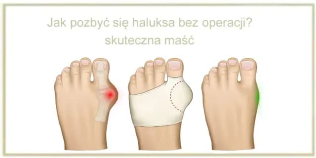 Jak pozbyć się haluksów: skuteczne metody bez operacji, które działają