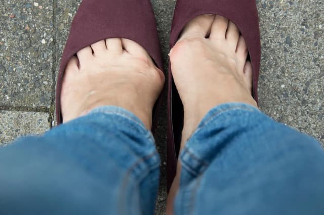 Jak walczyć z haluksami - skuteczne metody na ból i deformacje stóp